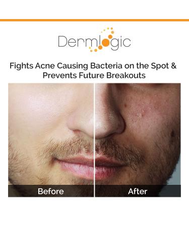 Acne Spot Treatment for Whitehead & Blackhead Pimples - Overnight Solution for Cystic Breakouts. Clears Severe to Mild Blemishes. Alcohol-Free Formula for Teens & Adults - Buy Online on GoSupps.com