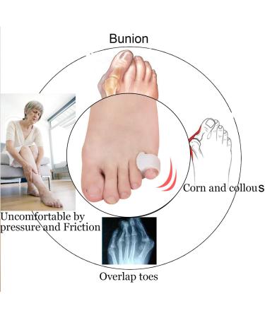 10 Pcs Pinky Toe Splint & Gel Toe Separators for Men & Women - Bunion Corrector & Relief - Buy Online on GoSupps.com