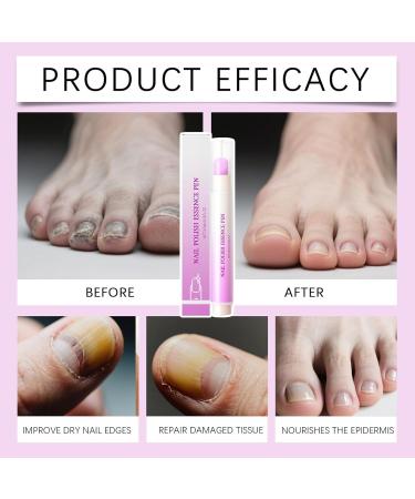 Huile Pour Cuticules Et Ongles - 3.5ml Stylo Liquide Nourrissant Fortifiant - Huile De Soin Renfor atrice Pour Cuticules - Pour Femmes Et Hommes Routine Quotidienne Manucure Soin Du Soir - Buy Online on GoSupps.com