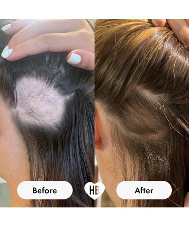 HAIR BURST Chewable Hair Vitamins for Hair Growth - Biotin Anti Hair Loss Thinning Hair Multivitamins - 30 Chewy Gummy Tablets - Buy Online on GoSupps.com