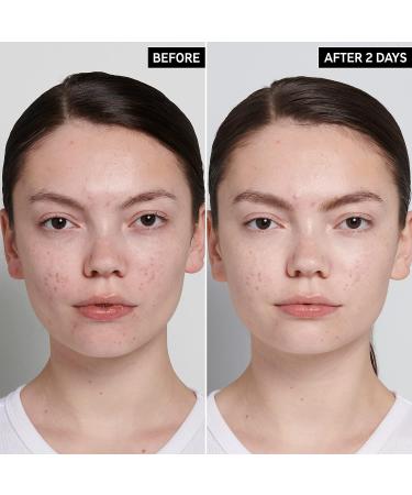 INKEY List Succinic Acid Acne Treatment - Clear Blemishes and Unclog Pores - 1% Salicylic Acid - 0.50 fl oz - Buy Online on GoSupps.com
