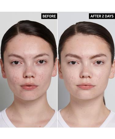 Buy INKEY List Succinic Acid Treatment Blemish & Oil Control 1% Salicylic Acid 0.50 fl oz - International Shipping Available - Buy Online on GoSupps.com