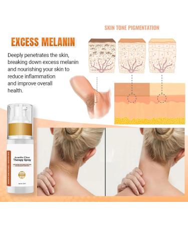 EXQST Acantho Clear Therapy Spray - Acanthosis Nigricans Treatment & Dark Spots Corrector Oil - Mild & Non-Stimulating Formula - 2 Pcs - Buy Online on GoSupps.com