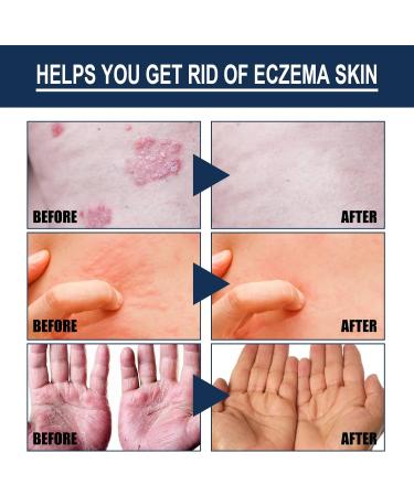 Natural Eczema Therapy Spray - Soothing Relief for Dry, Itchy Skin (5pcs) - Buy Online on GoSupps.com