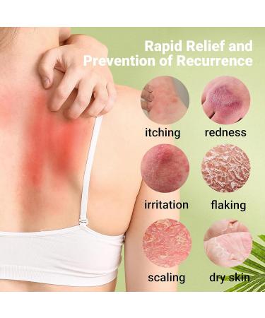 LMNOOP Psoriasis Cream - Maximum Strength Treatment for Psoriasis, Dermatitis, Rash - Fast Relief for Dry, Irritated Skin - 1.76 oz - Buy Online on GoSupps.com