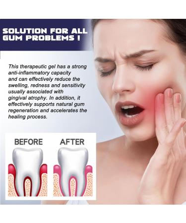 Mnozreo Instant gum treatment gel gum recurrence protection Gum Shield Therapy Gel 1 piece - Buy Online on GoSupps.com