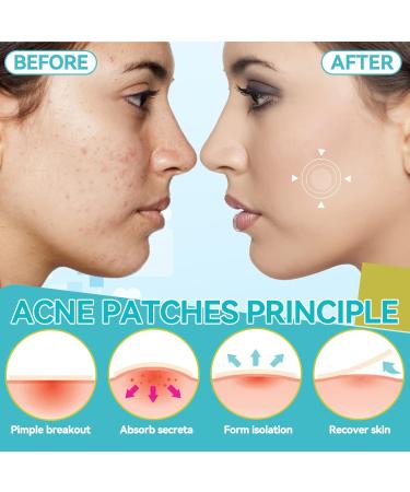 216 Pcs Invisible Hydrocolloid Pimple Patches with Tea Tree Oil - Waterproof & Breathable Acne Treatment for Day & Night - Buy Online on GoSupps.com