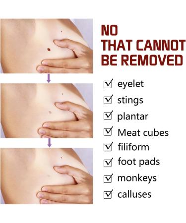 Wipe Off Moles & Skin Tags Remover Pen - Natural, Non-Irritating Formula for Easy Removal on Face & Body (2 PCS) - Buy Online on GoSupps.com