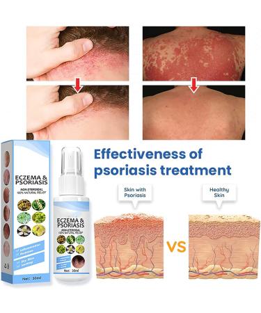 DUBUSH Meellop Herbal Psoriasis Relief Spray - Eczema & Psoriasis Treatment - Soothing & Moisturizing - 3PCS - Buy Online on GoSupps.com
