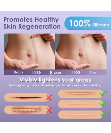 Skiennix Silicone Scar Sheets 1.6 x 120 Roll-3M | Medical Grade Reusable Scar Tape for Surgical Scars, Keloids, C-Sections | Painless Scar Treatment - Buy Online on GoSupps.com