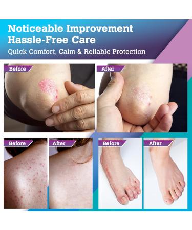 Cr me Antifongique Pied et Mycose Peau: Pityriasis Versicolor creme Soin Topique pour Pied Aine Aisselle et Plis Confort Protection et Hygi ne Quotidienne purple - Buy Online on GoSupps.com