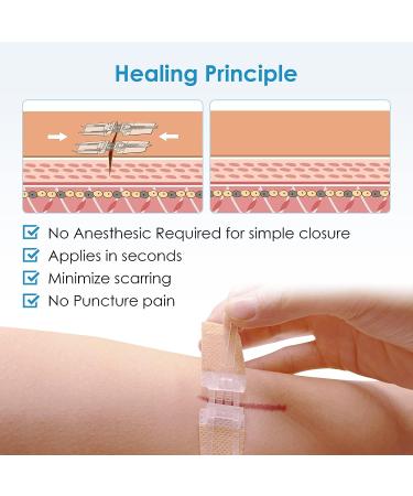 SEABIRD Emergency Zip Wound Closure Strips Bandages Kit - Pack of 6 - Painless Laceration Repair Without Stitches - First Aid & Wound Care Beige - Buy Online on GoSupps.com