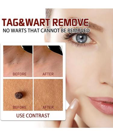 ZRREMRE Skin Flaps and Birthmark Remover Wipe Away Skin Flaps and Birthmarks 3 Pack Extreme Removal Instant Painless Removal for Skin Warts and Birthmarks - Buy Online on GoSupps.com