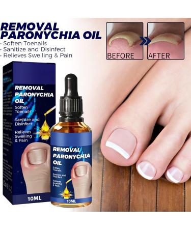 German Ingrown Toenail Drop: Paronychia Oil for Toenail Care - Nail Repair Solution (1pc) - Buy Online on GoSupps.com