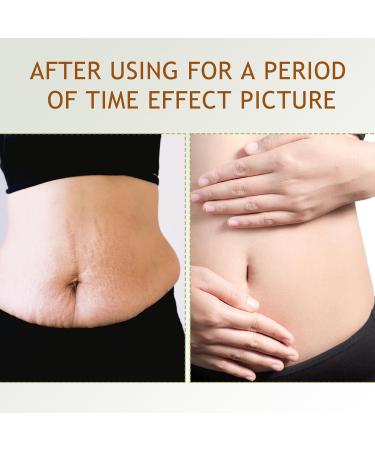 B Flat Belly Firming Cream - Stretch Mark Treatment - Clean and Gentle Belly Cream - Skin Tightening Creams for Cellulite for Stomach Mark & Thighs & Butt Moisturizing Lifting Body Lotion(100ml 1 Pack - Buy Online on GoSupps.com