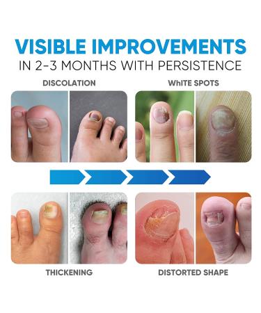 Advanced Nail Fungus Cleaning Laser Treatment Device - Home Use Toenail Therapy - Buy Online on GoSupps.com