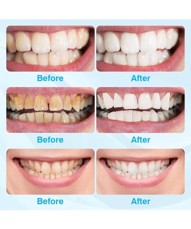 Douceur Teeth Whitening Kit - 5 Whitening Gels, 16 LED Lights - Non-Sensitive, Pain-Free Home & Travel Whitening Solution - Buy Online on GoSupps.com