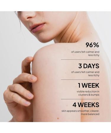 BellamiLuxx Fungal Acne Treatment Lotion: Effective Face & Body Pimple Cream for Bumps Clusters Itch & Redness Fungal Prone Skin Acne Treatment Moisturizer for Teens & Adults with Natural Actives - Buy Online on GoSupps.com