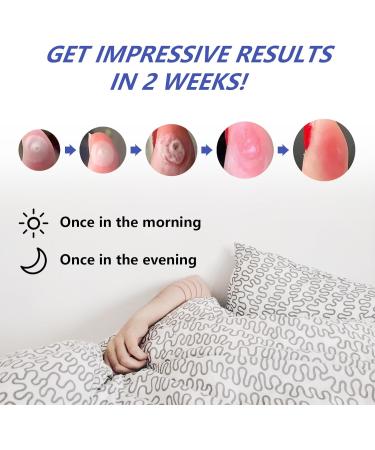 Fast-Acting Liquid Wart Remover for Plantar Wart Treatment - Removes Corns and Smoothes Skin - All Skin Types - Buy Online on GoSupps.com