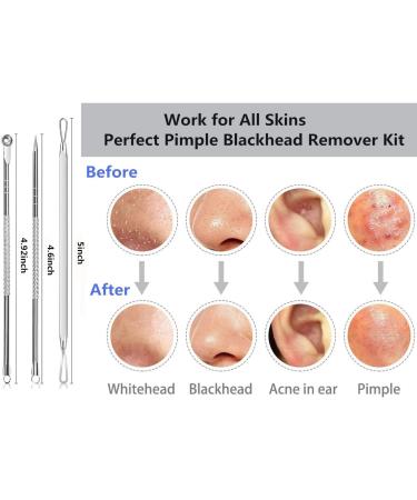 Blackhead Remover Tool Kit with Facial Cleansing Brush 3 Pieces Comedone Extractor Tool Blemish Whitehead Removal Acne Needle Pimple Spot Popper with Cleansing Blackhead Brush - Buy Online on GoSupps.com