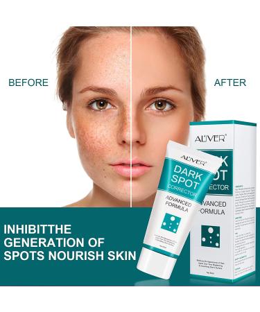 Dark Spot Corrector & Remover | Fade Black Precipitate, Remove Freckles | Dark Spot Correcting Cream - Buy Online on GoSupps.com