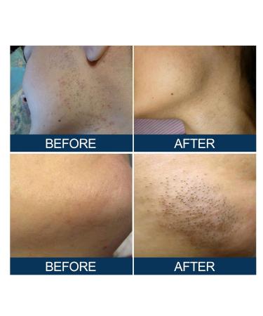 30 Ml Bumps Solution - Mild Moisturizing After Shave Repair Serum for Ingrown Hair | International Shipping Available - Buy Online on GoSupps.com