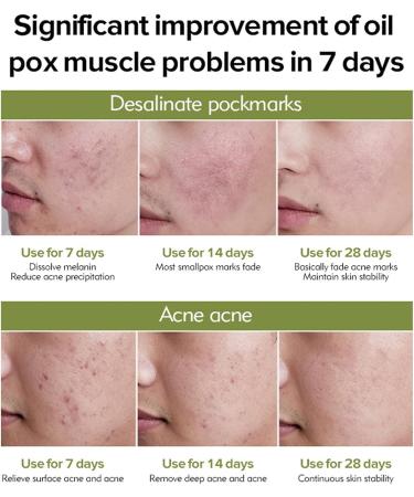 Acne Repair Face Serum Firming Serum For Face Green Tea Hyaluronic Acid Serum Relieve Redness & Acne Natural Face Serum For Acne Day & Night Serum For Face Hydrating Face Oils And Serums-Repair - Buy Online on GoSupps.com
