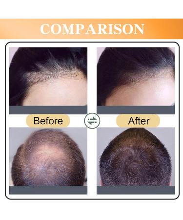 Buy Hair Growth Spray & Serum with Rosemary Oil - Thicker Longer Healthier Hair | International Shipping - Buy Online on GoSupps.com