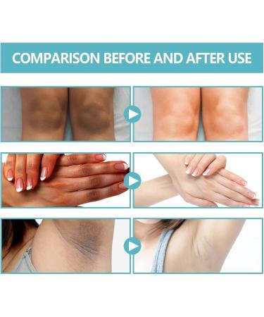 Dark Knuckles Whitening Serum 50g Acanthosis Nigricans Therapy Cream Dark Spot Corrector Cream Dark Spot Remover for Underarms Knees Elbows Inner Thigh - Buy Online on GoSupps.com