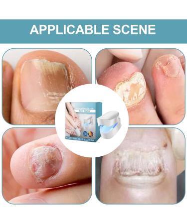 Acunny Nail Cleaning Device Nail Cleaning Device Nail Cleaner Conditioner for Damaged and Discolored Nails | Home Use Nail Cleaning Lamp Device - Buy Online on GoSupps.com