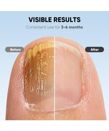Buy Nail Fungus Light Device for Home Use - Treat Onychomycosis on Fingernails & Toenails | Effective for Damaged Discolored & Thickened Nails - Buy Online on GoSupps.com