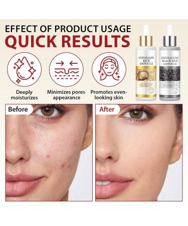 Black Rice Exfoliant and White Rice Peeling Glow Ampoule 100ml 2 PCS White & Black Rice Facial Serum Soft Exfoliating Face and Body Dead Skin Cells for All Skin Types - Buy Online on GoSupps.com
