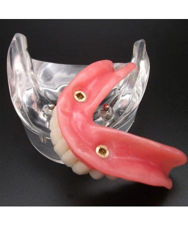 Dental Teeth Model - Lower Removable Overdenture with 2 Implants | Dentist Assistant Supplies - International Shipping - Buy Online on GoSupps.com