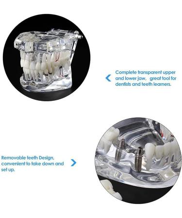 Buy DYTAH Transparent Teeth Model - Removable Pathological Tooth for Dental Training & Examination | International Shipping - Buy Online on GoSupps.com