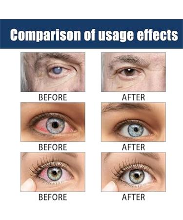 New Anti-Fatigue Clear Vision Eye Drops Eye Drops Relieve Red Eyes and Dry Eyes Cooling Eye Strain Relief Clear Eyesight Nursing Astigmatism - Buy Online on GoSupps.com