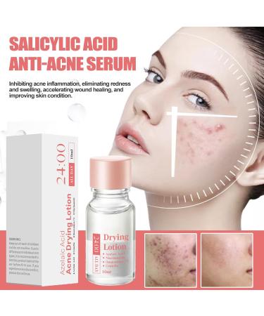 Spot Lotion 10 ml Drying Solution for Spots and Moisturizers | Fast-Acting Liquid for Facial Blemishes for Women for Daily and Nighttime Use Travel and - Buy Online on GoSupps.com