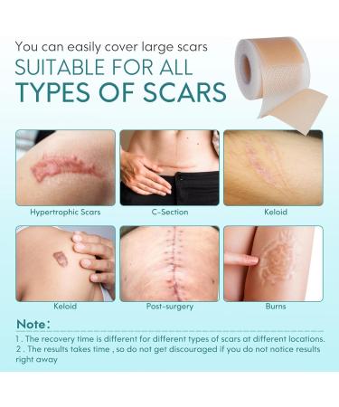 Silicone Scar Roller Tape - Reusable 4m x 4.6cm for Scar Removal & Keloid Treatment - Ideal for Caesarean Scars & Facial Scarring - Buy Online on GoSupps.com