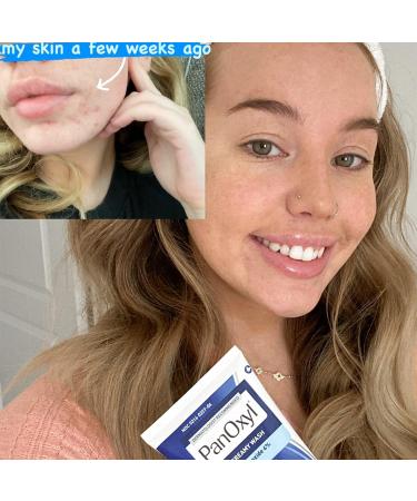 PanOxyl Antimicrobial Hydrating Acne Creamy Wash 4% Benzoyl Peroxide 6 Ounce (Pack of 2) - Buy Online on GoSupps.com