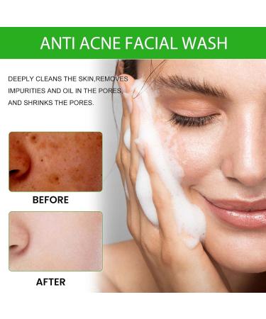 Acne-Fighting Facial Cleanser - Deep Cleanse Remove Oil Dirt Blackheads & Pimples Shrink Pores Refreshing & Comforting(2PCS) 1 Count (Pack of 1) - Buy Online on GoSupps.com