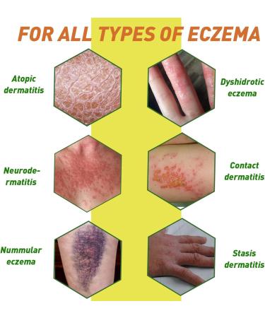 DUBOONAIO High Strength Bee Venom Cream Dyshidrotic Eczema Ointment Heat Rash Itching Eczema Psoriasis Leg Stomach Foot Hand Irritated Skin All Age Care - Buy Online on GoSupps.com