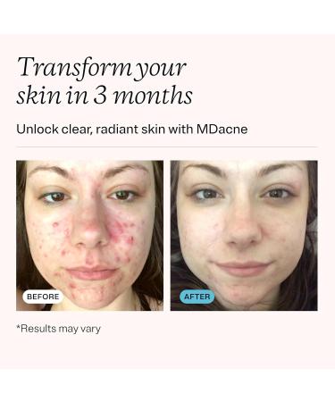 MDacne - Acne Treatment- Benzoyl Peroxide Cream 5% - Unclogs Pores Reduces Blemishes & Enhanced with - Plant-Based Ingredients for Sensitive Skin - Buy Online on GoSupps.com