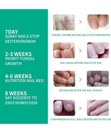 Kerassentials Toe Nails Lotion - Advanced Oil Formula with Applicator (3pc) | Reviews - Buy Online on GoSupps.com