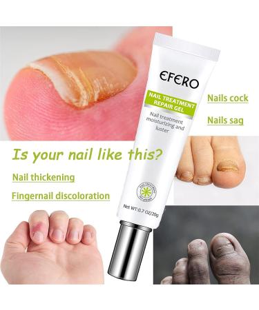 2PCS Nail Repair Essence Cream - Restores Discolored/Damaged Nails - Toe Beauty Cream for Toenail Care - Buy Online on GoSupps.com