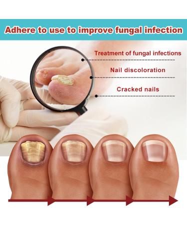 Toe Nail Patches for Fungus - Fast & Effective Nighttime Renewal | 16 Safe Fungal Nail Patches for Ultimate Foot Care - Buy Online on GoSupps.com