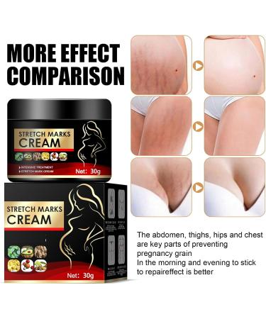 Cr me pour varices limination des varices r parateur de varices cr me pour varices jambes varices enflamm es 20 g 1 pi ce - Buy Online on GoSupps.com