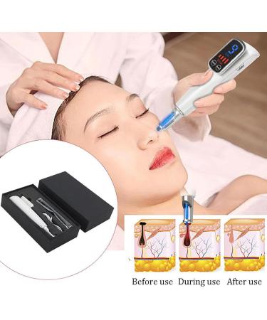 Stylo Picoseconde avec Cran LCD 9 Niveaux De Fr Quence + 4 Niveaux D'Intensit pour Liminer Les Tatouages Cicatrices Grains De Beaut Taches De Rousseur Et Taches Brunes Blue - Buy Online on GoSupps.com