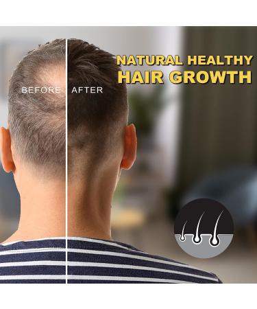 5% Minoxidil Hair Growth Oil for Men & Women - Biotin Serum for Hair Regrowth, Thicker Fuller Hair - 2.02 oz - Buy Online on GoSupps.com