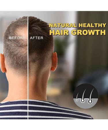5% Minoxidil Hair Growth Serum for Men & Women | Biotin Hair Regrowth Treatment | Thicker Fuller Healthier Hair - 2.02oz - Buy Online on GoSupps.com