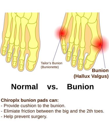 Chiroplax Bunion Gel Pads - Toe Separator & Relief Cushion for Hallux Valgus - Pack of 4 (2 Pairs) - Buy Online on GoSupps.com