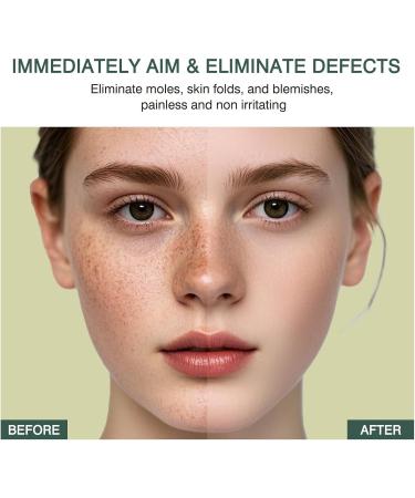  SONGVISON Instant Mole & Spot Removal Gel Dark Pigment Lightening Gel Skin Correcting Moisturizing Serum for Women - Buy Online on GoSupps.com